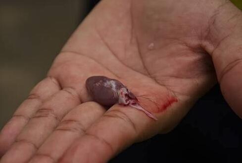 是女中豪杰吗?女子生吞蛇胆中毒 听信