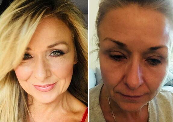 什么鬼?化妆25年从不卸妆 50岁美国妇女眼睑下方长黑色硬块