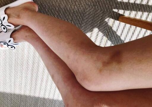 惨不忍睹!林允双腿淤青 减肥过度减出了