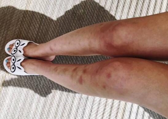 惨不忍睹!林允双腿淤青 减肥过度减出了