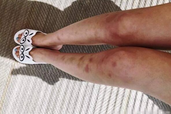 小仙女怎么了？林允双腿淤青 网友喊话喊话赶快去医院