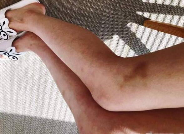 小仙女怎么了？林允双腿淤青 网友喊话喊话赶快去医院