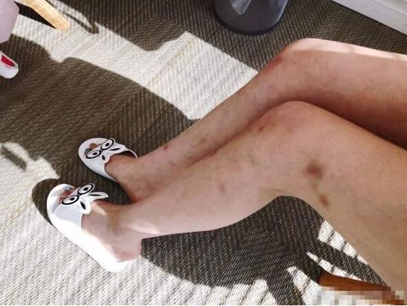 小仙女怎么了？林允双腿淤青 网友喊话喊话赶快去医院