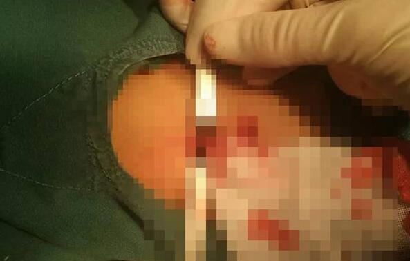 大连:男童气管被狗咬穿 医护团队连夜手术修复破损气管