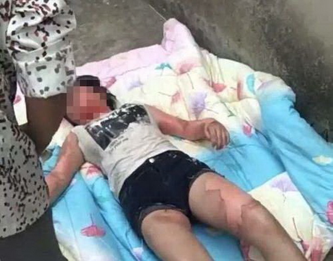 太惨了！女孩被开水灌入喉咙烫伤严重 大人的感情纠葛为啥要波及到孩子？