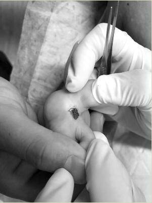 一家三人被蜱虫咬伤两人丧命 病毒感染有全身