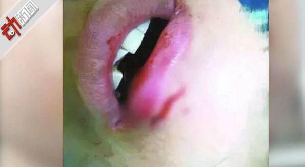 水杯自爆案一审 女子被宜家水杯炸断牙判赔4万将再上诉