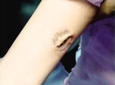 女护士手臂被患者咬住忍痛坚持 为保患者引流管硬挺3分钟