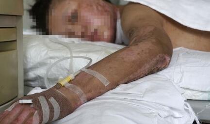 惨不忍睹!18岁女孩被烧伤 全身烧伤面积超过50%血肉模糊