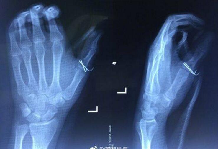 肥宅快乐水出事了！男子手指被可乐炸骨折 冰阔洛威力这么大