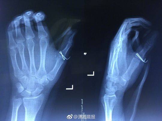 可乐能当炸弹用？手指被可乐炸骨折 像他这样喝可乐要出大事