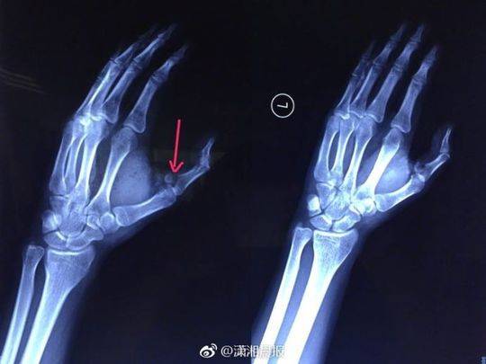 可乐能当炸弹用？手指被可乐炸骨折 像他这样喝可乐要出大事