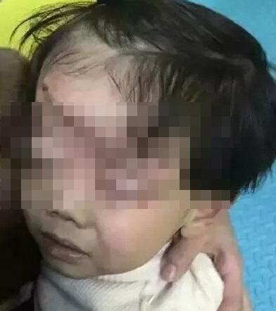 男童被游乐车挤伤 4岁童不慎被游乐车挤压头部颅骨骨折