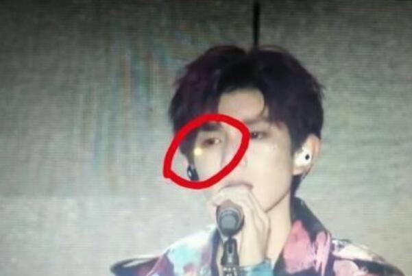 吓skr人!王源眼睛疑受伤 5周年演唱会