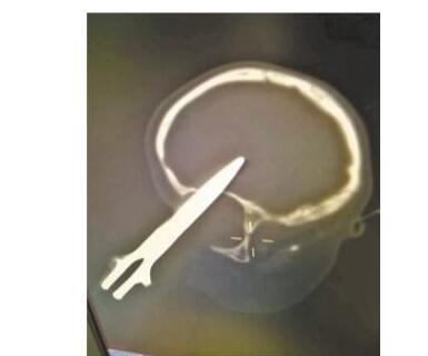 还敢疏忽吗?剪刀插入男孩左眼进入脑部5cm 妈妈离开2分钟内发生惨剧