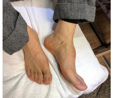 黄晓明回应增高鞋垫质疑 独家限量高脚背注入6粒钢钉