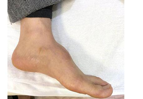 黄晓明回应增高鞋垫质疑 独家限量高脚背注入6粒钢钉