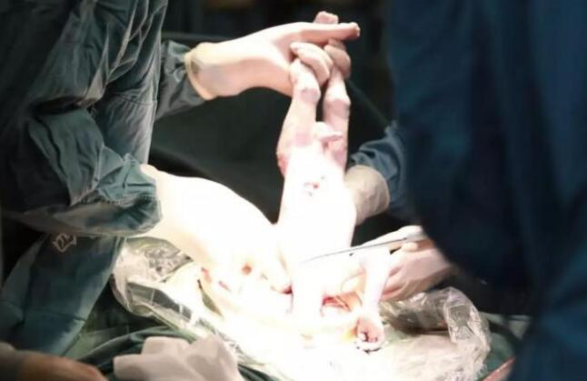 为医学点赞!中国首例添宫宝宝诞生 子宫移植成功产下男婴