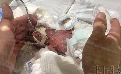 世界最小男婴出院 医生:即使出生时很小的婴儿也能健康出院!