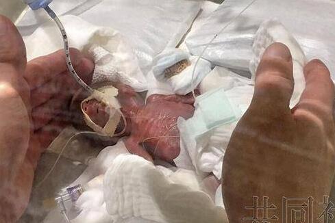掌上明珠！世界最小男婴出院是什么情况?体重从274克涨到3238克