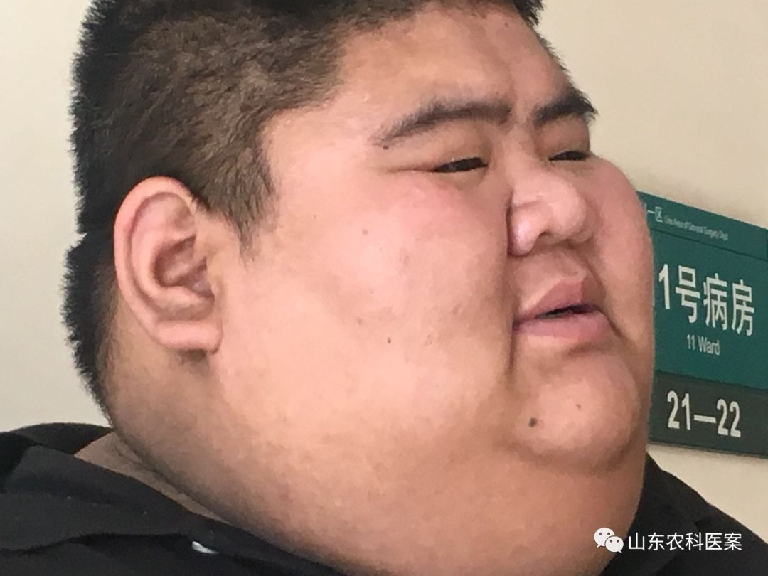 “山东第一胖”十个月减重363斤,他是如何做到的?