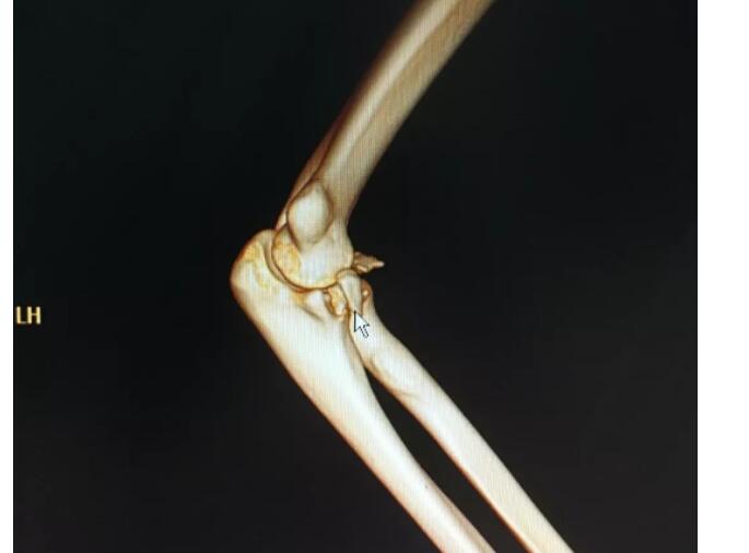 惊呆了!公主抱女友手骨折 这到底是个什么情况?还原事件始末真相