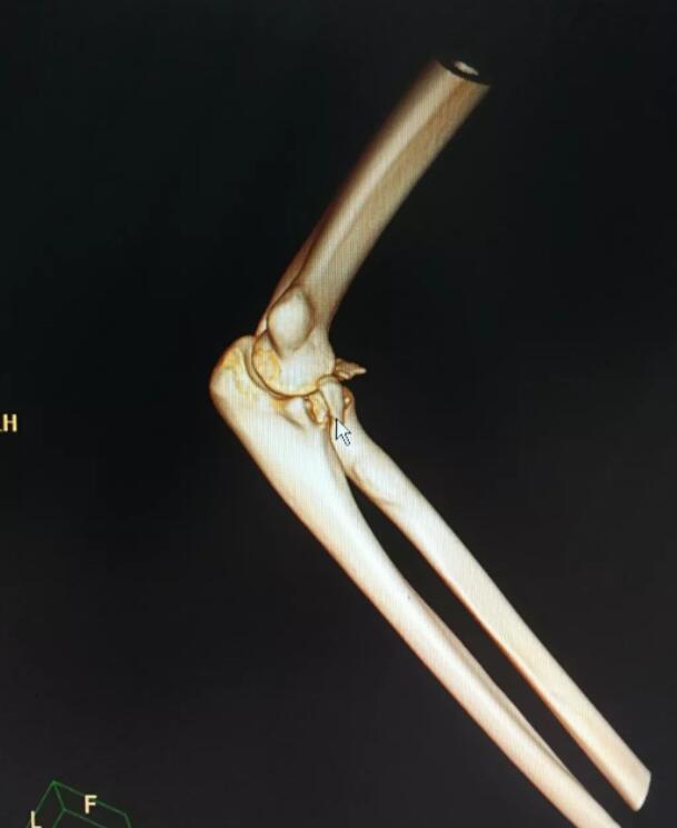 真相哭笑不得！公主抱女友手骨折什么情况？这到底是怎么一回事