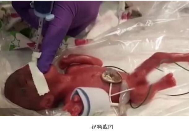 奇迹婴儿！最小存活婴儿出院这到底是怎么一回事 生命伟大珍贵