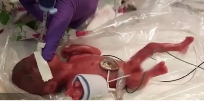 令人心疼！最小存活婴儿出院是什么情况?还原“苹果宝宝”详情始末