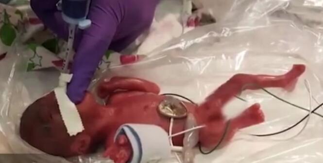 手动怒赞!最小存活婴儿出院 详情始末曝光不得不感谢生命有奇迹