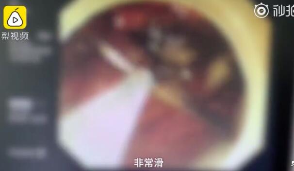 怎么做到的?女孩醉酒吞下汤勺 酒醉后含着15公分汤勺无意识吞下