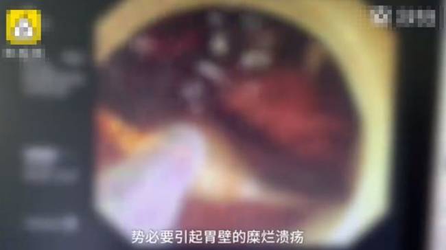 女孩醉酒吞下汤勺是什么情况?怎么一回事?终于真相了,原来如此!