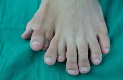 一足生9趾怎么回事?年轻小伙子左脚生9趾,买鞋只穿大两码