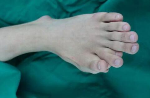 一足生9趾怎么回事?年轻小伙子左脚生9趾,买鞋只穿大两码