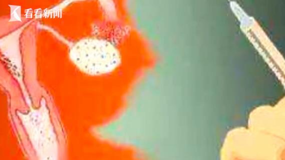 女孩多次捐卵生命垂危 腹痛、腹腔内出血，生育受到影响