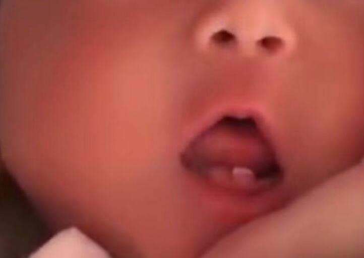 奇怪！女婴出生长两颗牙 医生告诉她这种牙叫做“诞生牙”