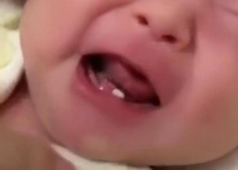 奇怪！女婴出生长两颗牙 医生告诉她这种牙叫做“诞生牙”