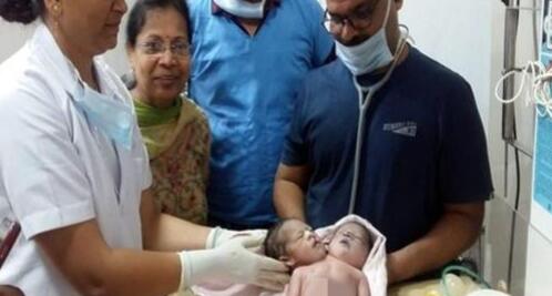 惊呆了!畸形男婴吓晕产妇 孩子有两个头和三条手臂