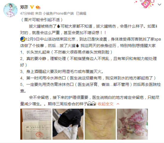 伤的怎样?邓莎拔火罐被烧伤什么情况?现场图来了