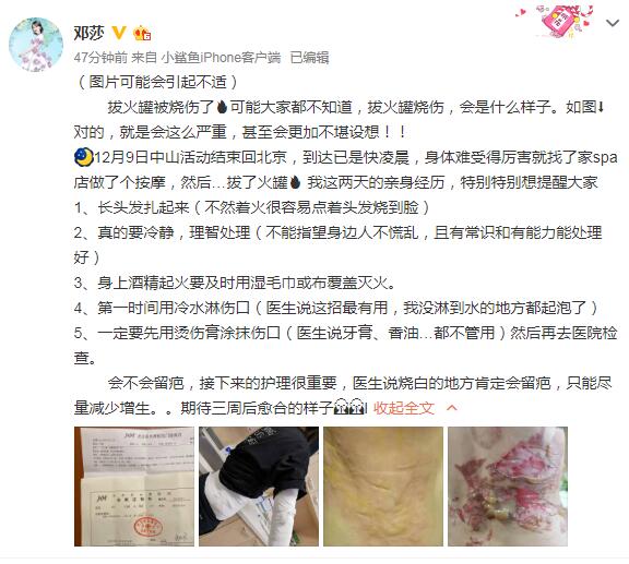 邓莎拔火罐被烧伤是怎么回事？终于真相了，原来是这样！