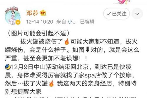 触目惊心！邓莎拔火罐被烧伤是怎么回事 邓莎拔火罐被烧伤事件始末