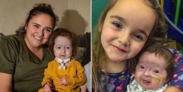 太罕见了!英国2岁女童患怪病面容衰老,详情曝光让人心疼!