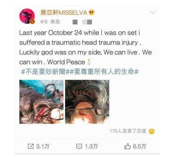 萧亚轩公开意外受伤照片怎么回事?终于真相了,原来是这样！