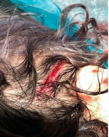 萧亚轩公开意外受伤照片怎么回事?终于真相了,原来是这样！