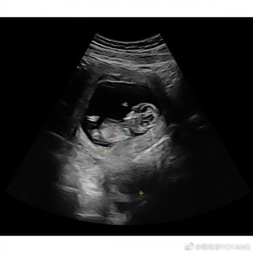 杨祐宁还贴出了一张b超照片,宣布未婚妻已经怀孕