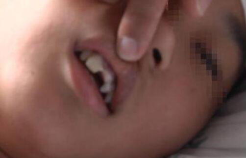 噩梦！戒网瘾学校待三天全身多处淤青 12岁孩子四颗门牙全都晃动哭诉像地狱