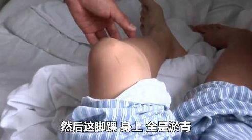 【最新】戒网瘾学校待三天全身多处淤青 戒网瘾学校待三天全身淤青事件详情始末曝光