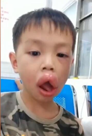 东成西就梁朝伟!男孩吃葡萄过敏肿成嘟嘟嘴 具体是怎么回事?