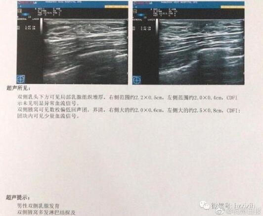 心态崩了!26岁小伙健身3个月乳房发育是怎么回事?具体发生了什么？ 