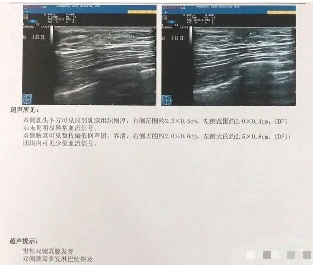 26岁小伙健身3个月乳房发育怎么回事?什么情况?终于真相了,原来是这样！